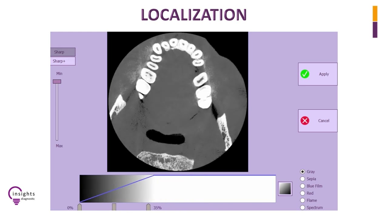 Insights Diagnostic - iRYS Software Tutorial - Localization of a Region of Interest