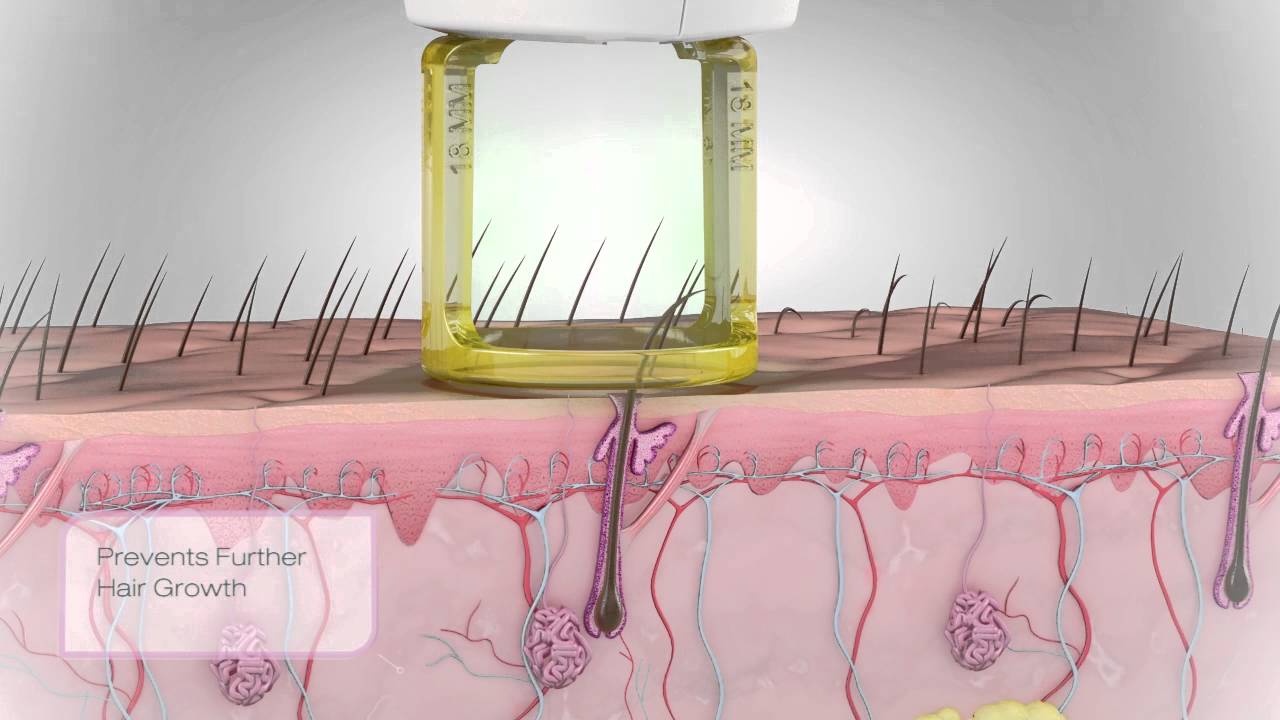 Gentle Hair Removal