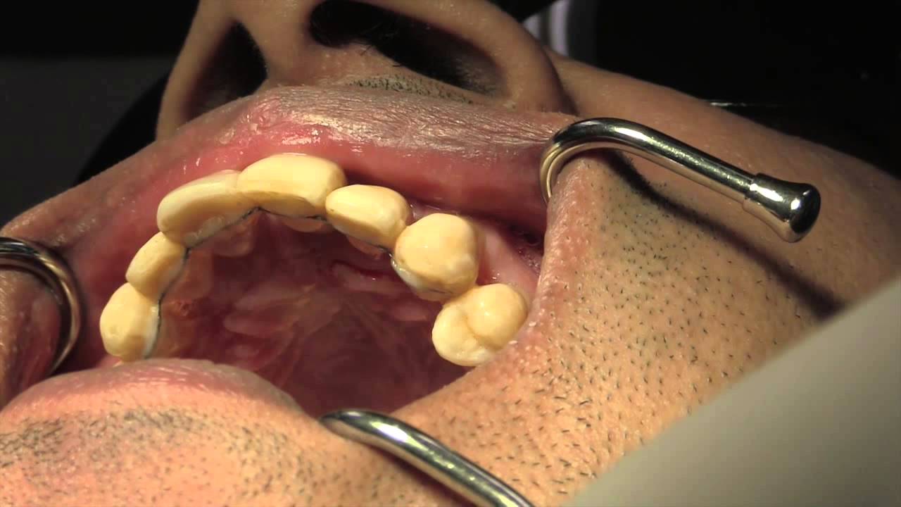 DentalVibe System for a Painless Dental Injection