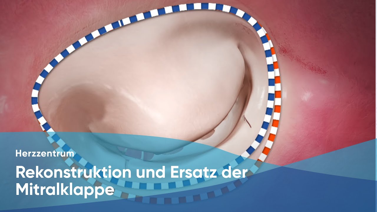 Rekonstruktion und Ersatz der Mitralklappe