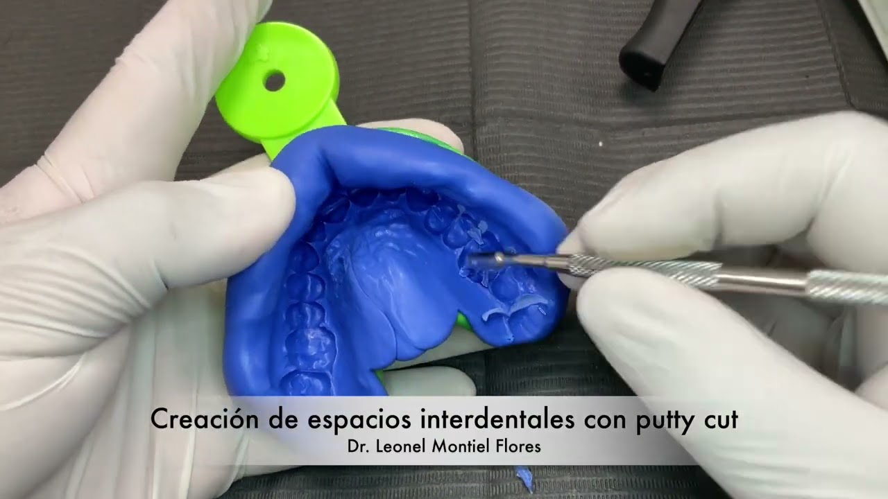 Impresión a 2 pasos con Polivinilsiloxano