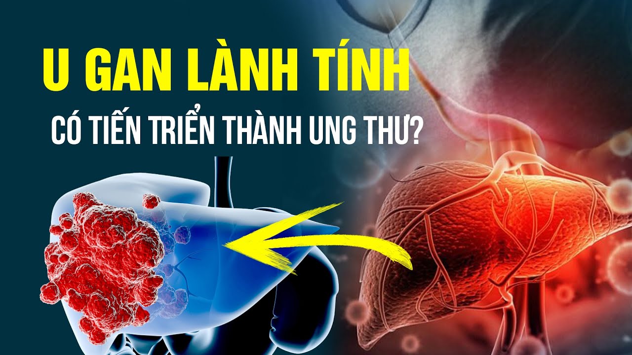 U Gan Lành Tính, Có Tiến Triển Thành Ung Thư? Triệu Chứng & Cách Điều Trị|THS.BS.CK2 Trần Kinh Thành