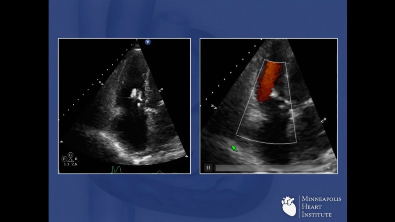 Novel Application of MitraClip for the Tricuspid Valve - Paul Sorajja, MD