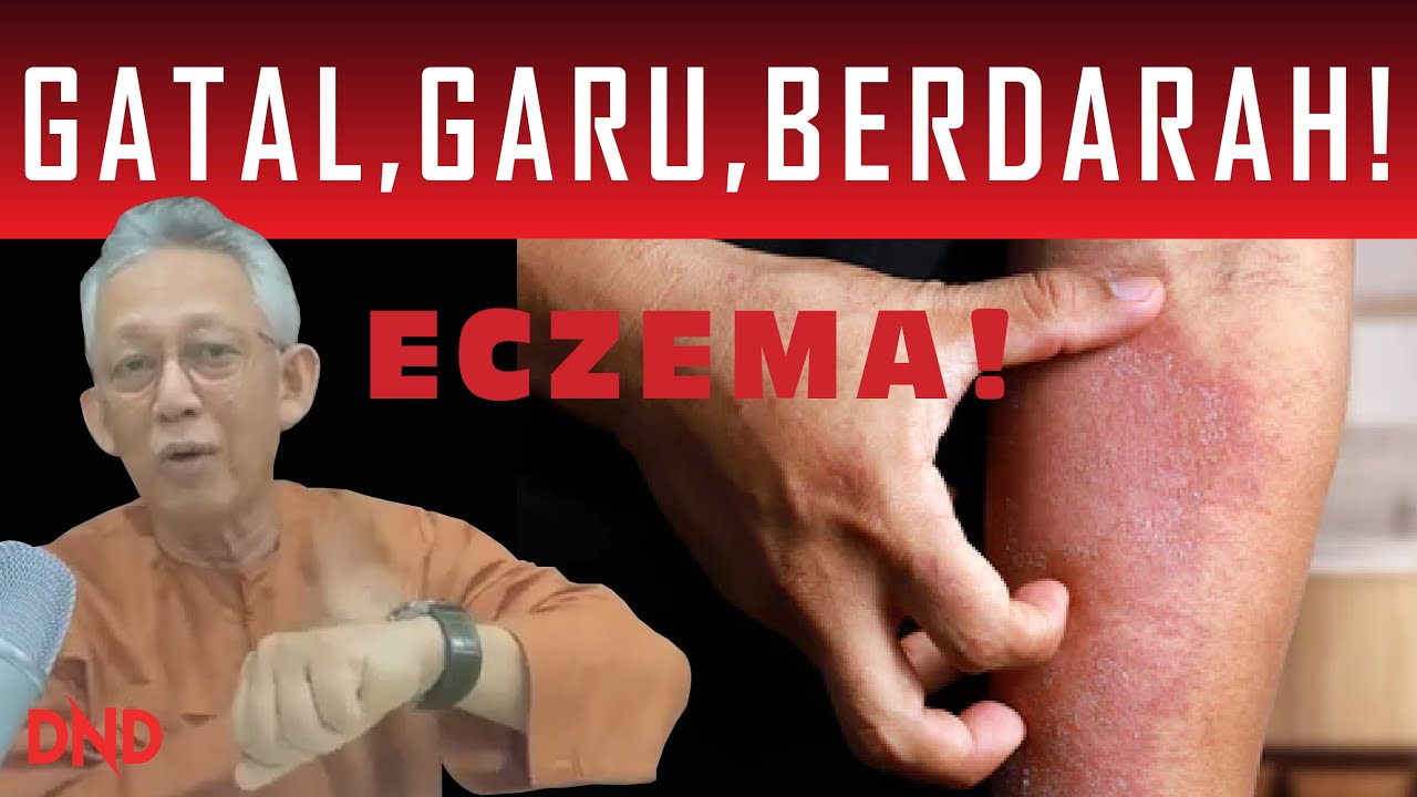 GATAL, GARU, BERDARAH!.....ECZEMA!