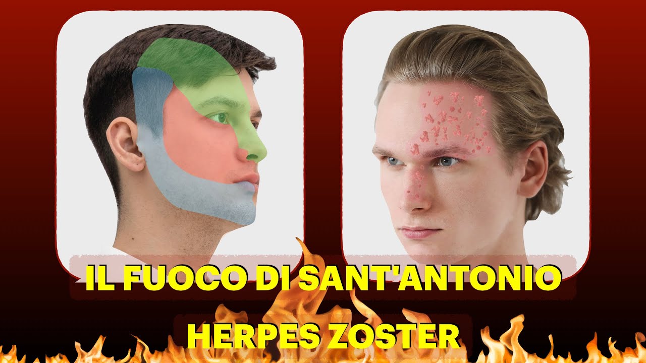 Il fuoco di Sant'Antonio - Herpes zoster