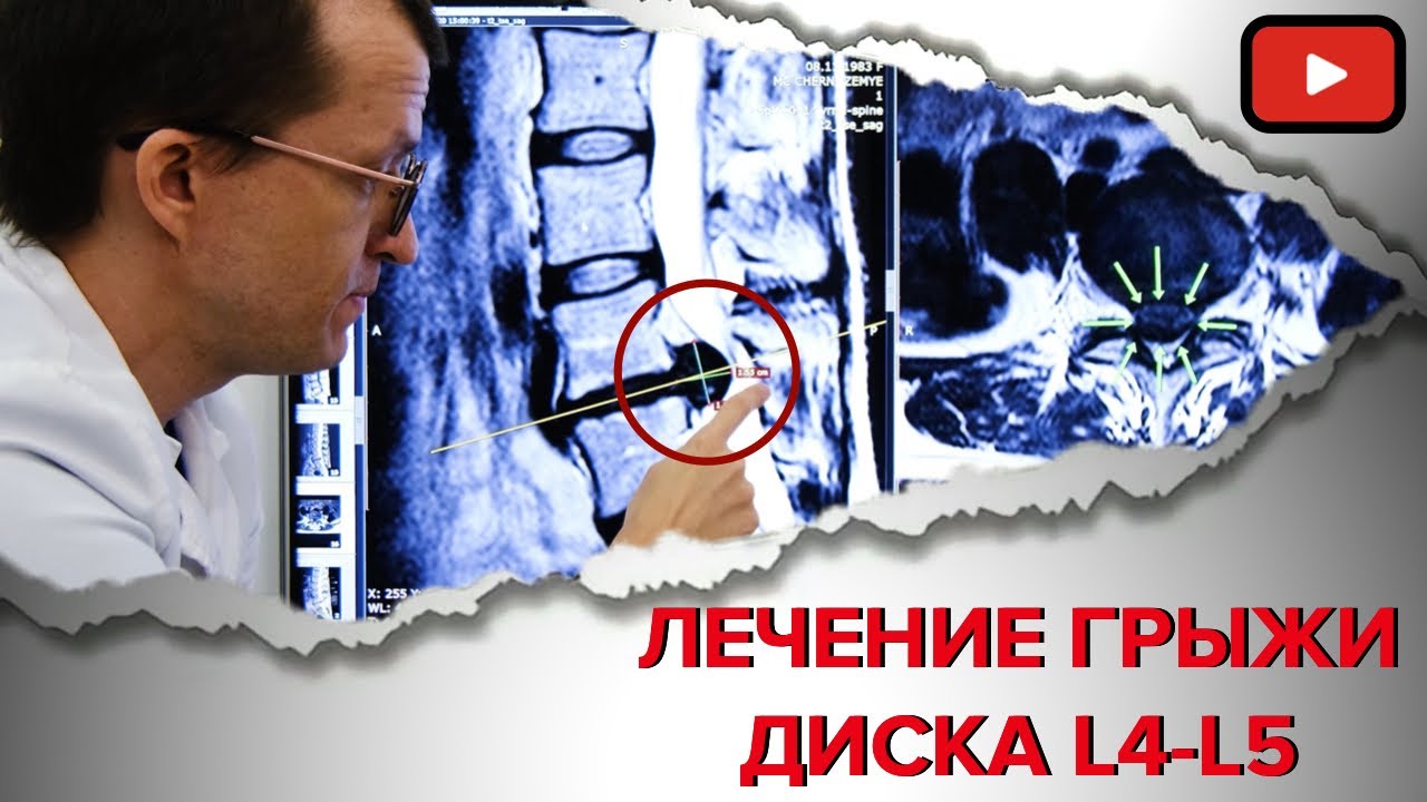 ВЫЛЕЧИЛИ ГРЫЖУ ДИСКА L4-L5