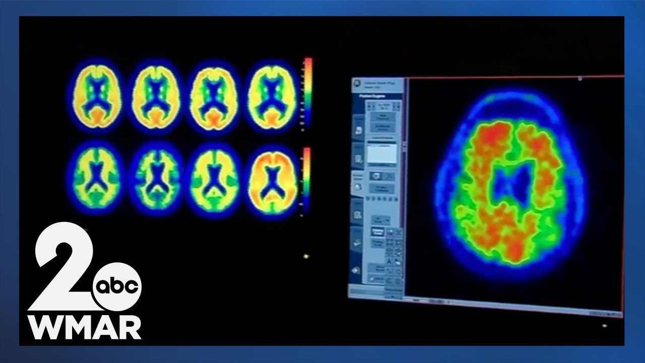 Possible new treatment for agitation in Alzheimer's patients