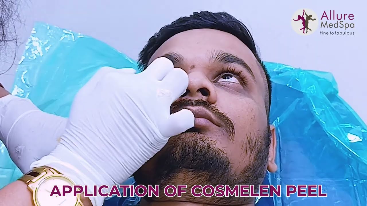 3 Simple Steps to Reduce Dark Circles with Cosmelan Peel Treatment in Mumbai | Dr Milan Doshi