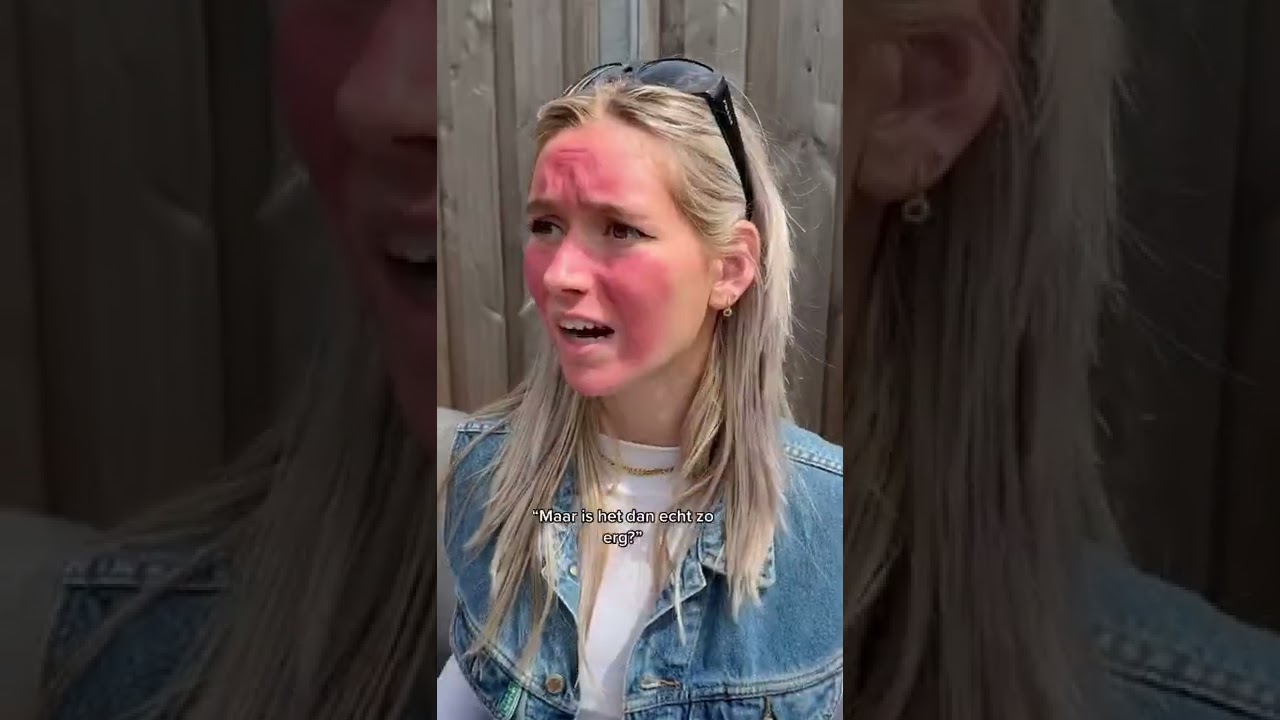 Maxime haar gezicht is volledig verband😱☀️