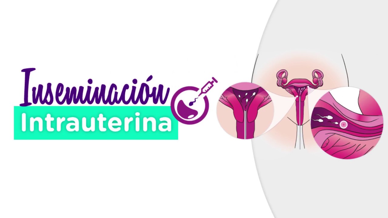 Inseminación Intrauterina
