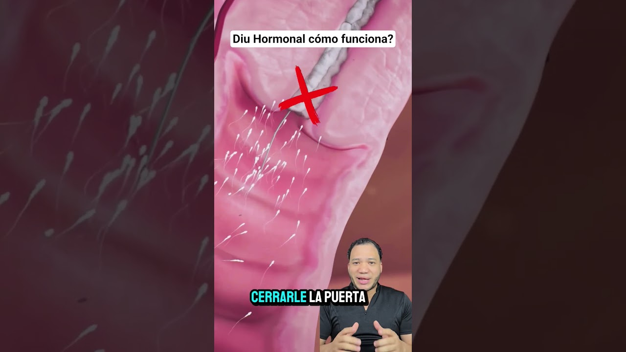 Diu Hormonal, como funciona?