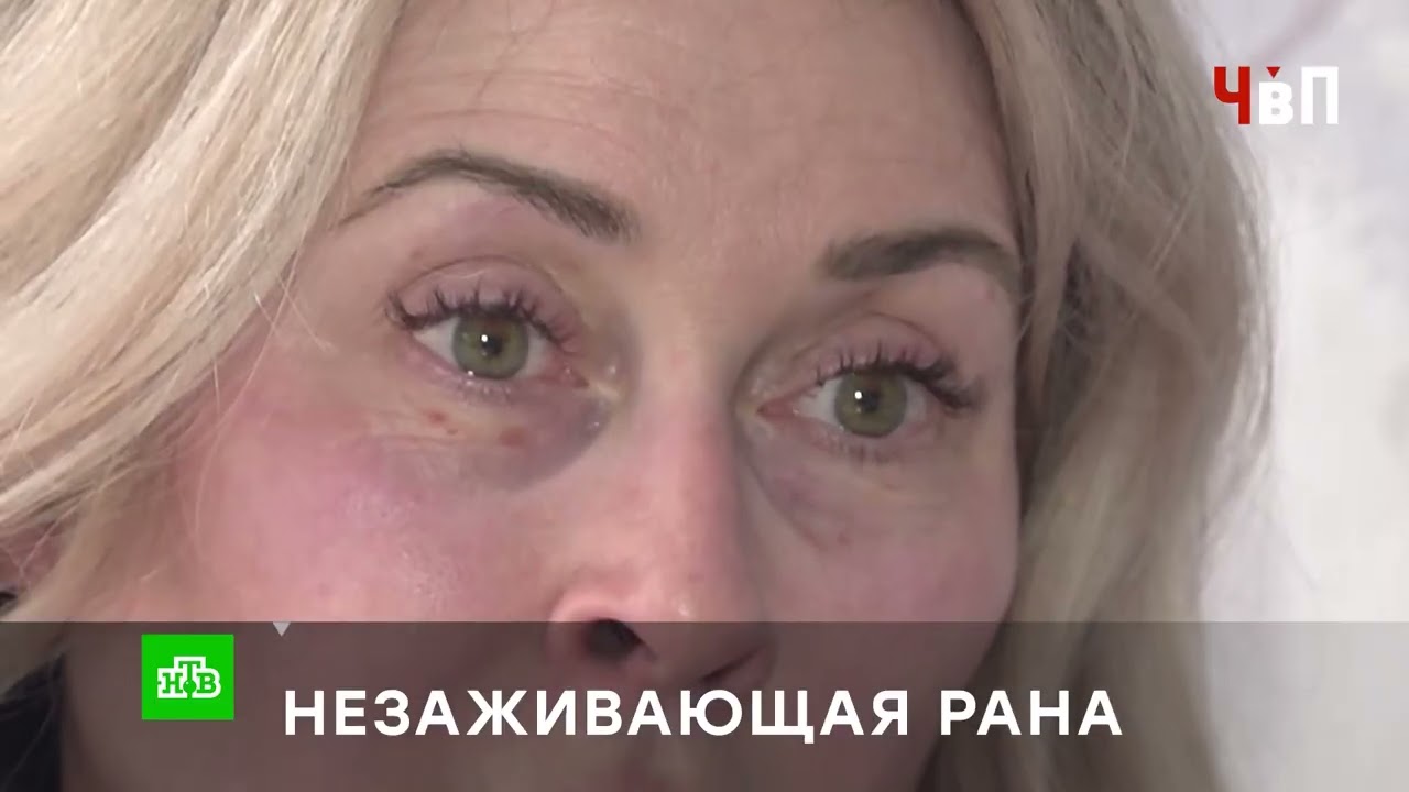 &laquo;НЕЗАЖИВАЮЩАЯ РАНА&raquo;