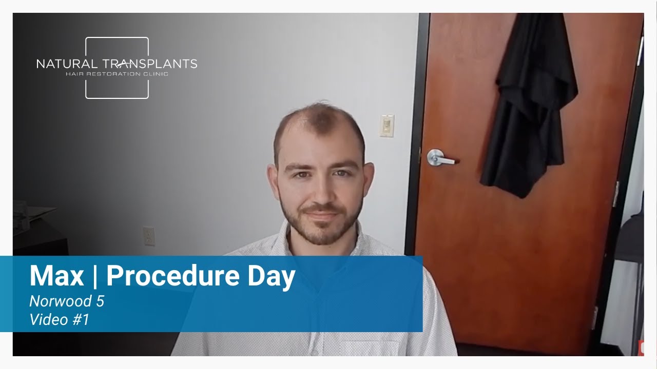 Procedure Day for Norwood 5 Patient with Fine Wispy Hair | Dr. Huebner (Max)