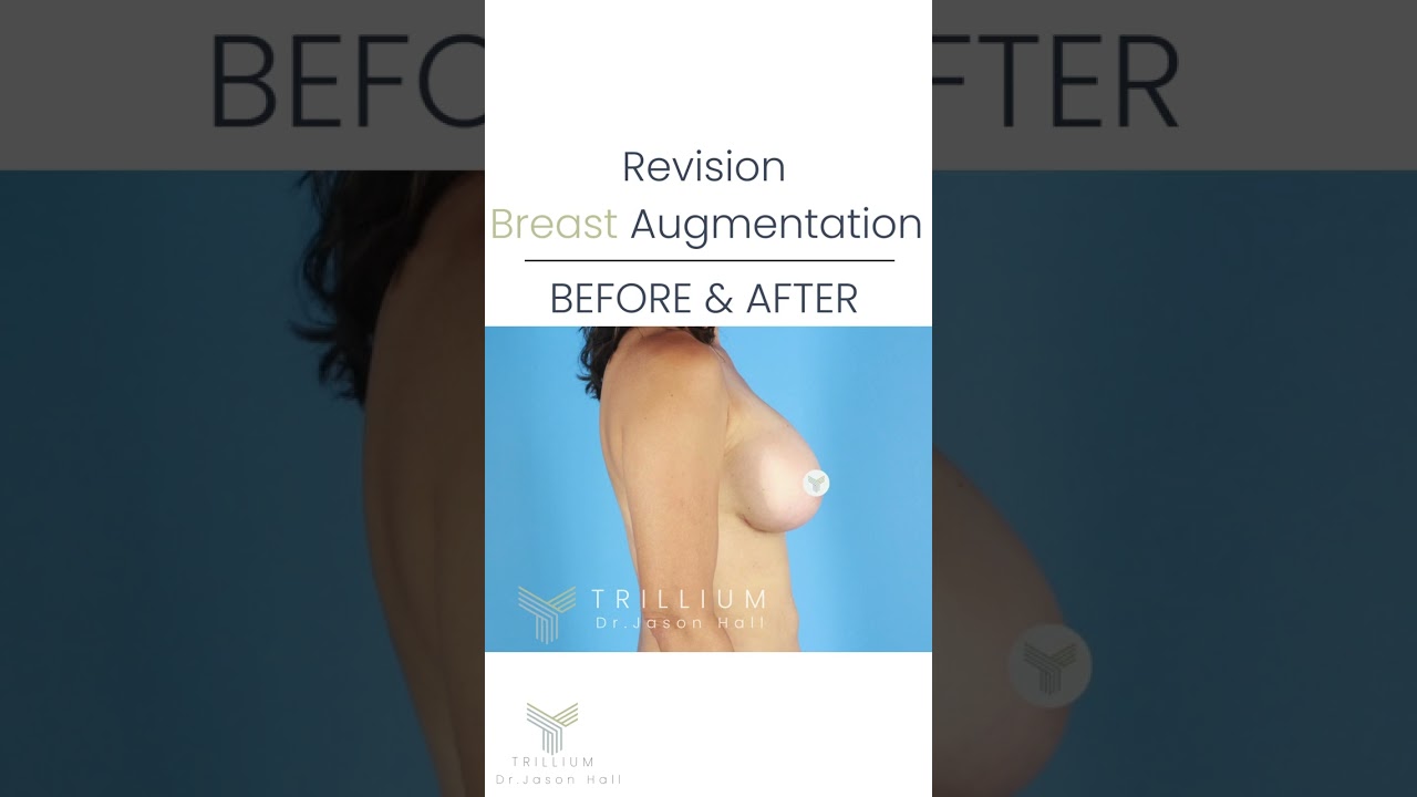 Breast Implants don't belong in your armpits!