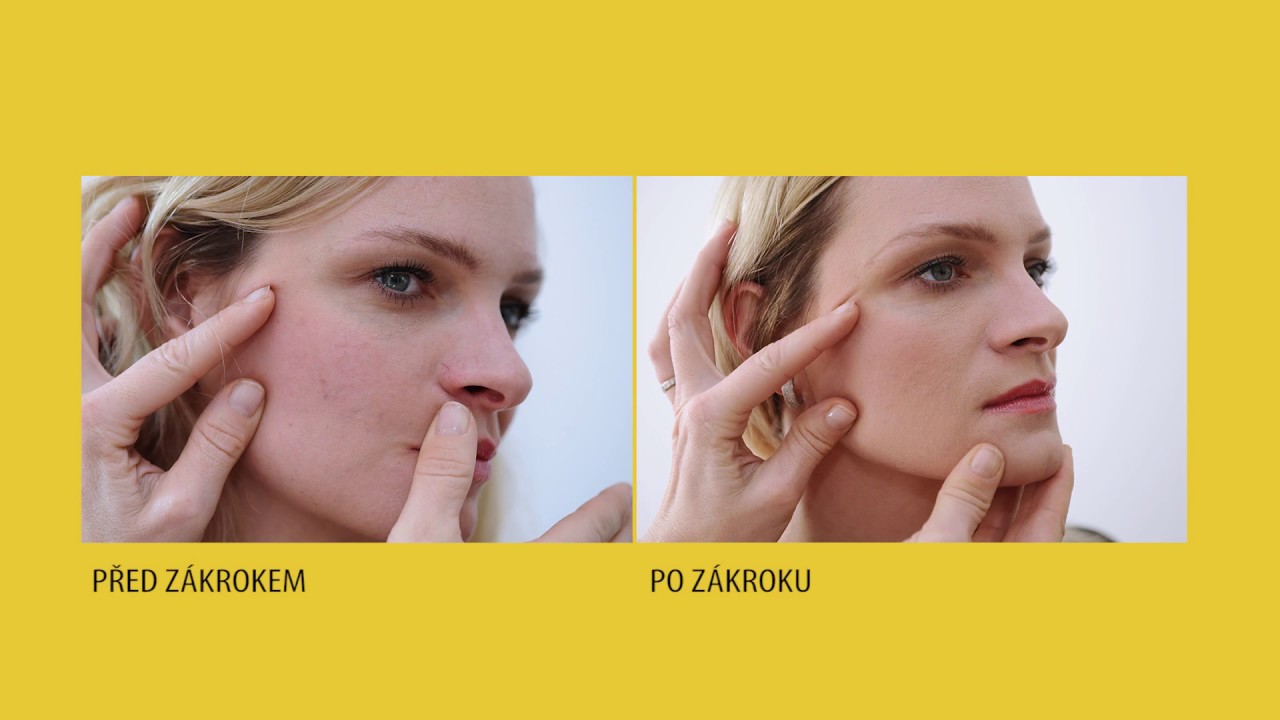 Odstraněn&iacute; žilek v obličeji laserem