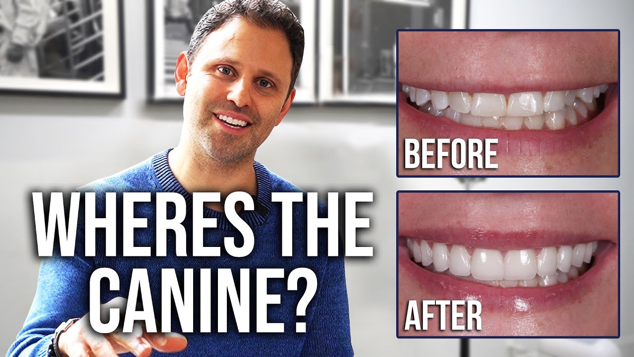 Where's The Canine? Full Smile Transformation Case | Dr. Alex NYC