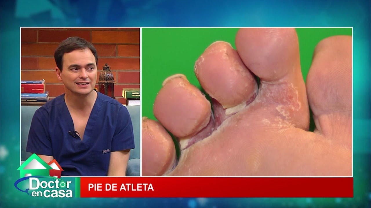 ¿A qué llamamos Pie de Atleta?