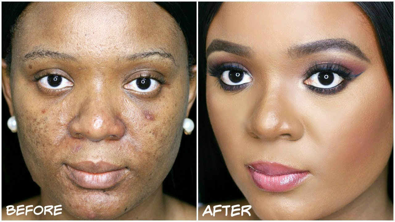 HOW TO COVER ACNE, DARKSPOTS & HYPERPIGMENTATION - MY ACNE COVERAGE FOUNDATION ROUTINE | OMABELLETV
