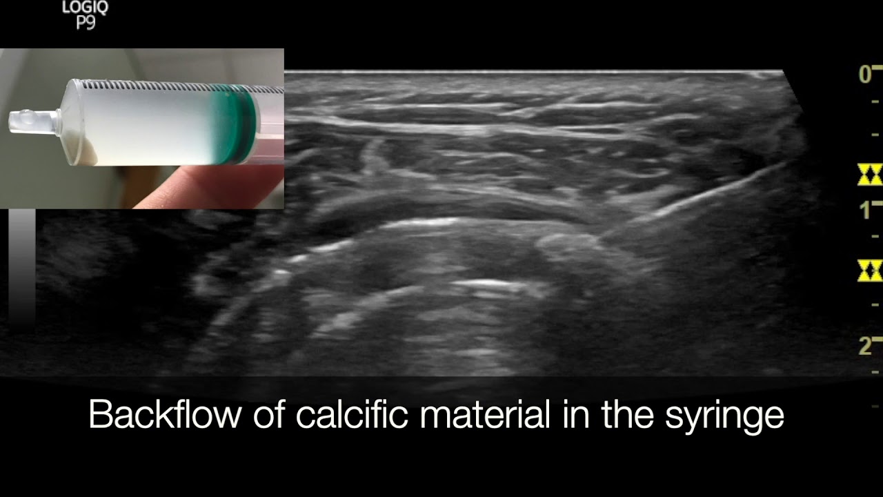 Ultrasoundguided lavage of calcium deposit in the rotator cuff.