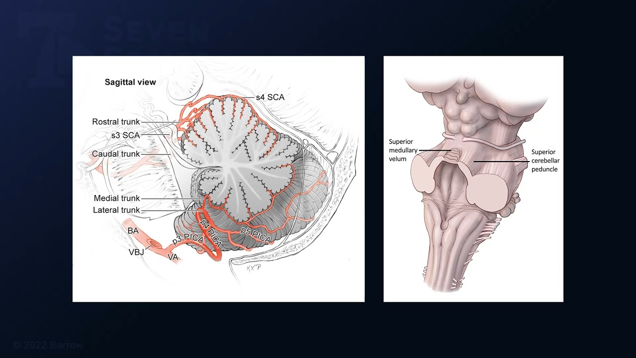 Posterior Interhemispheric-Transtentorial Approach: AVM of Superior Medullary Velum & 4th Ventricle
