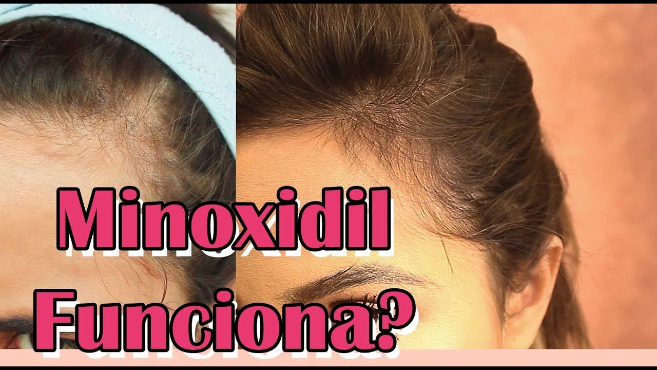 Usei MINOXIDIL POR 3 MESES E O RESULTADO FOI ESSE!