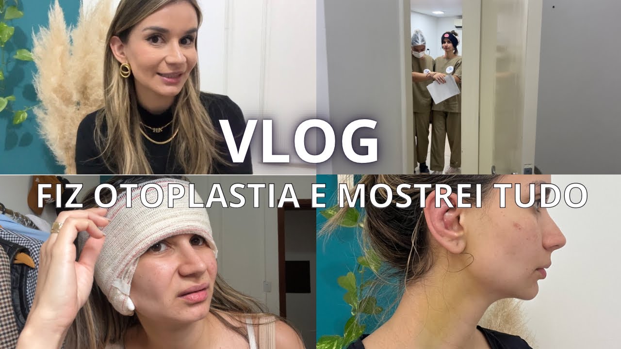 ANTES E DEPOIS DA MINHA CIRUGIA DE OTOPLASTIA - MOSTREI TUDO