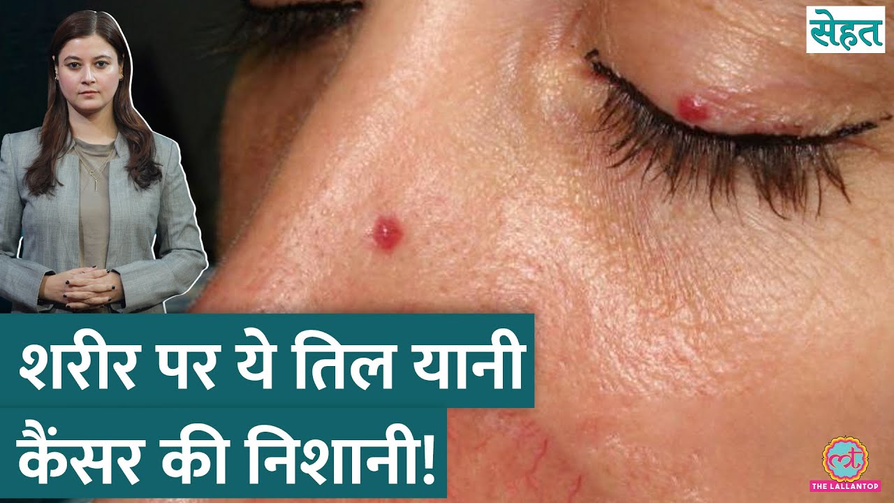शरीर पर लाल तिल Cancer या Liver Disease का इशारा? | Cherry Angioma| Sehat Ep. 1191