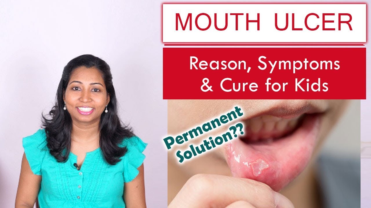 How to cure regular Mouth Ulcer in Kids | Reasons & Home Remedies