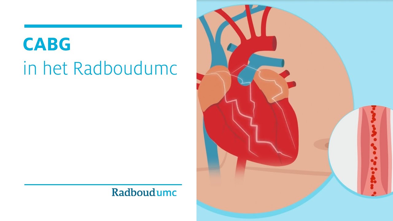 CABG - bypassoperatie