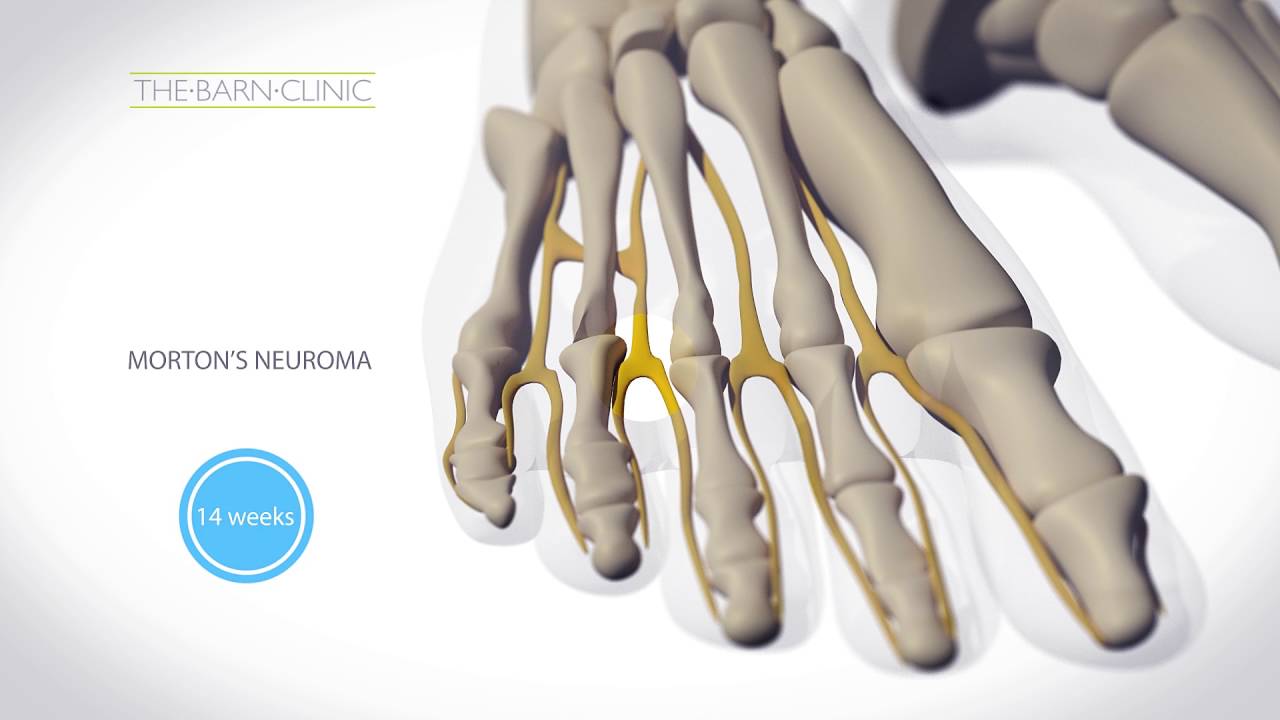 Cryosurgery for Morton's Neuroma at The Barn Clinic