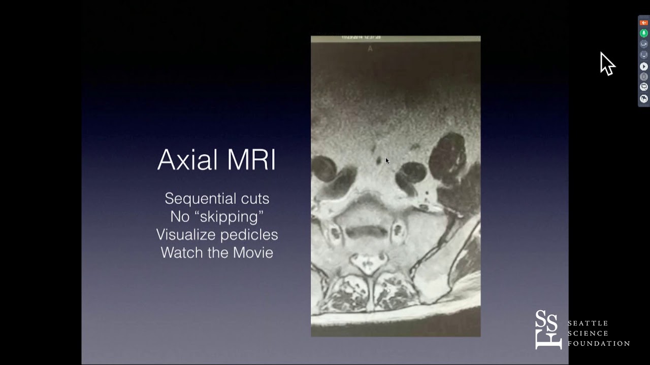 Oblique Lumbar Interbody Fusion OLIF  First and Last Case - John K. Shuster, MD