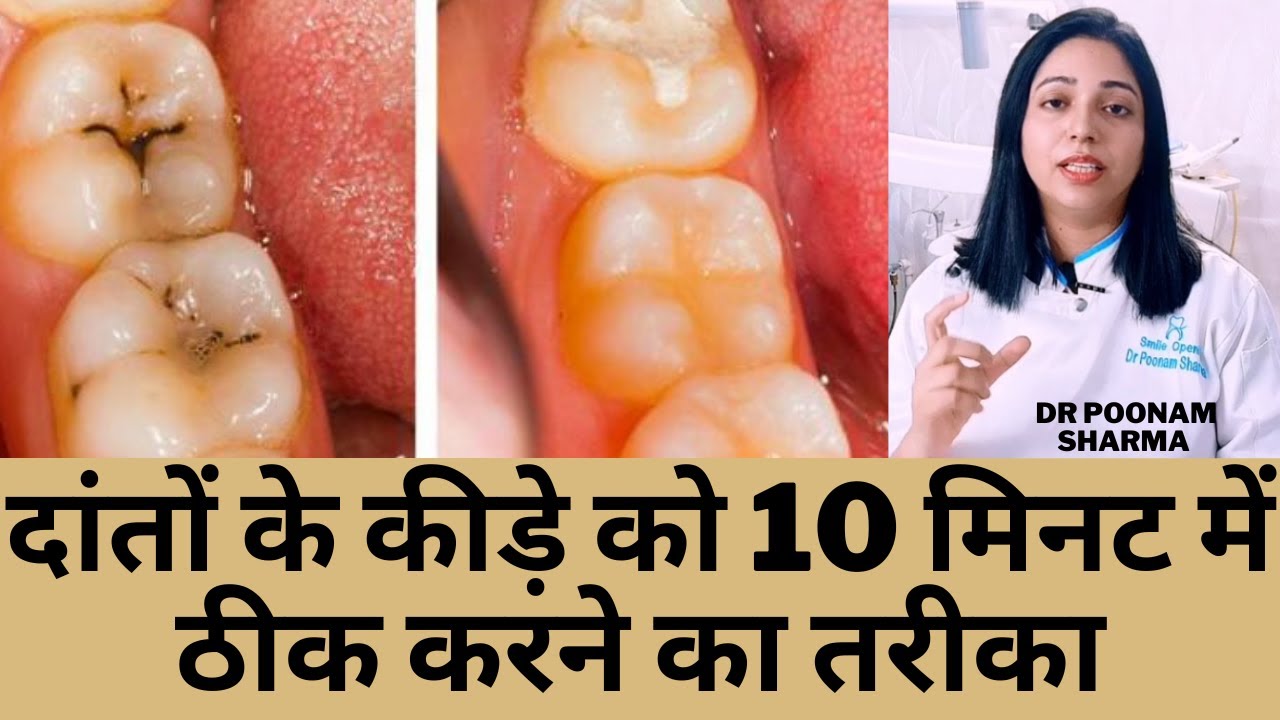 दांतों के कीड़े का इलाज | Treatment Of Tooth Decay #toothdecay #cavityfilling #dentalcavity