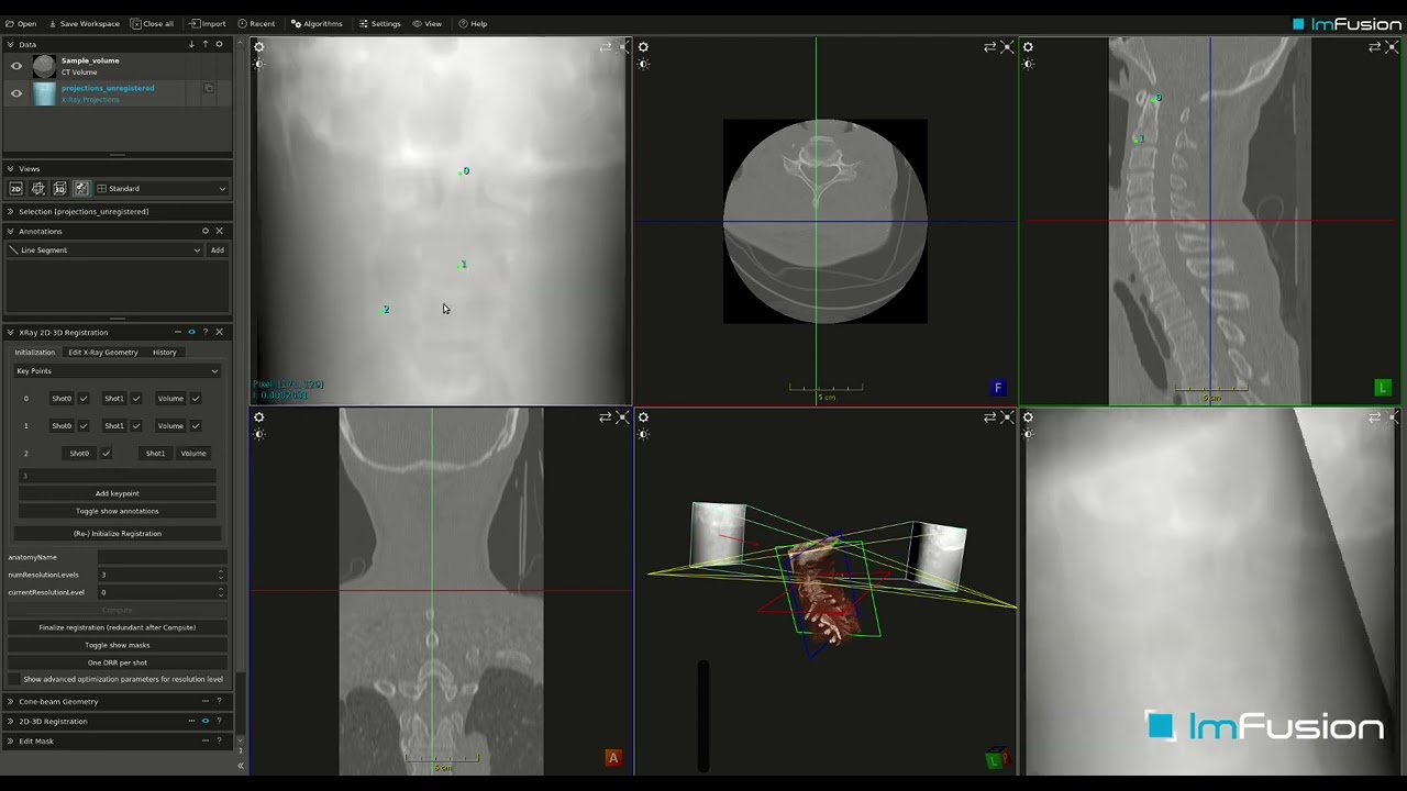 Enhance your 2D-3D Registration from CT to X-ray/Fluoro images with ImFusion Suite