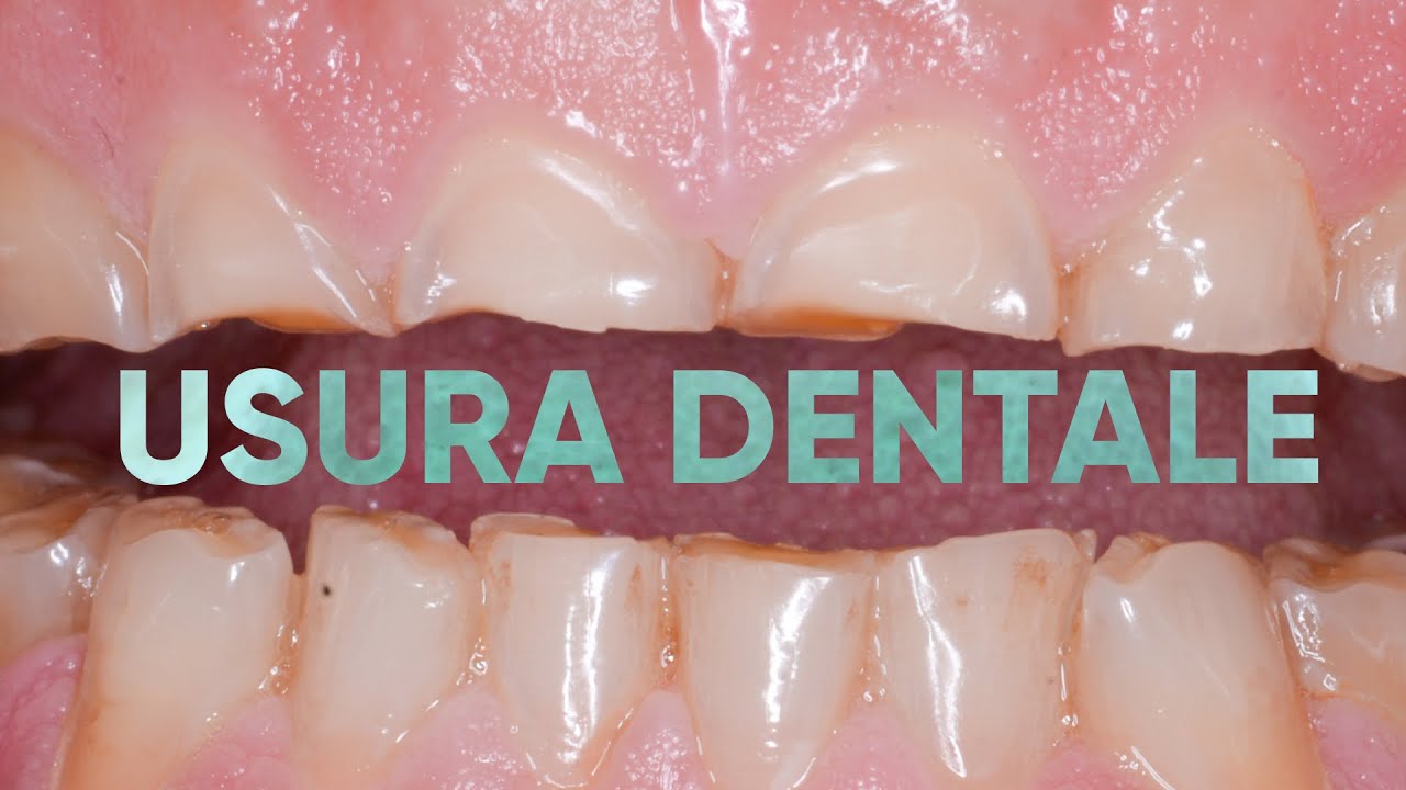 Scopri le Cause dell'USURA DENTALE: Erosione, Abrasione e Bruxismo