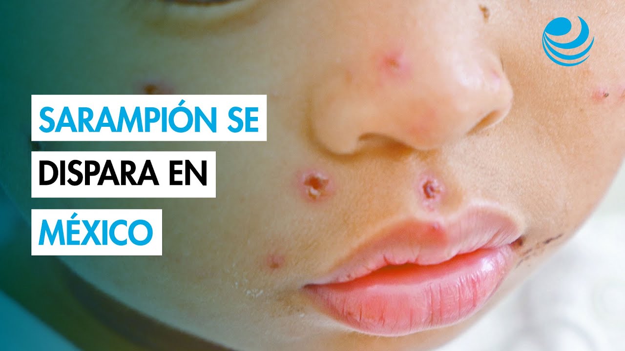 Sarampi&oacute;n: La importancia de la vacunaci&oacute;n ante el repunte de contagios