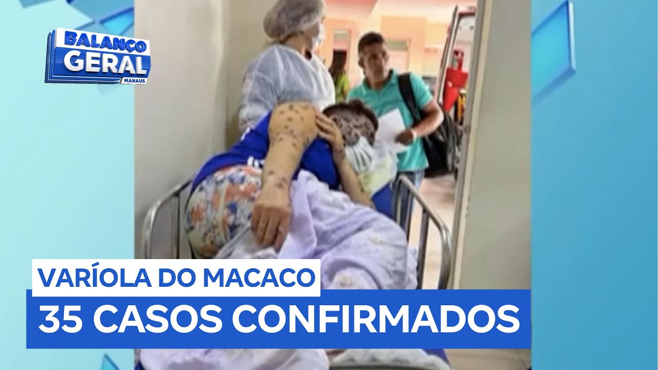 Casos de MPOX no Amazonas  Atualização e Medidas de Prevenção