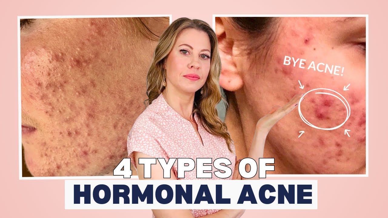 Acne Specialist Reveals 4 Hormonal Acne Types and How to Fix Them