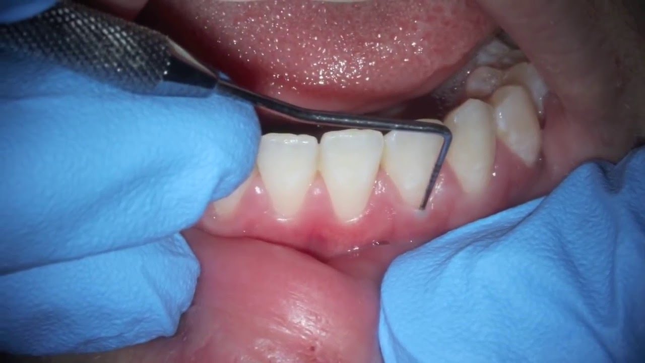 treating anterior puffy gums