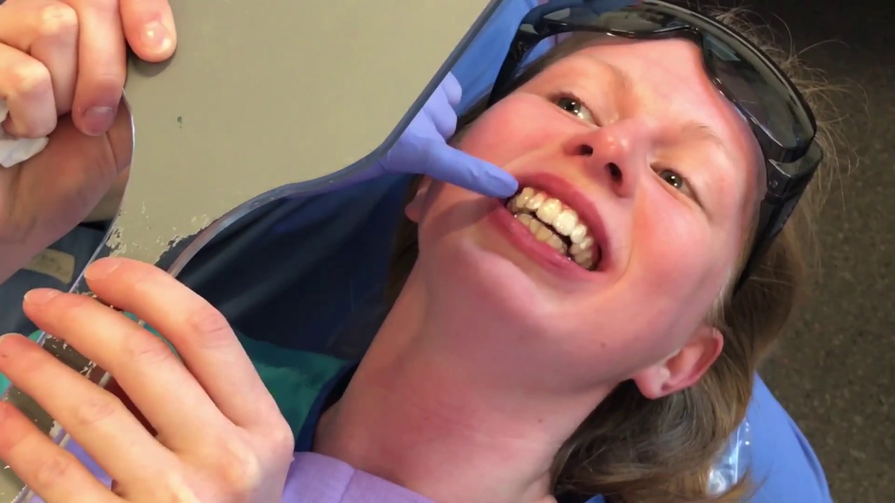 Fitting Invisalign Clear Braces