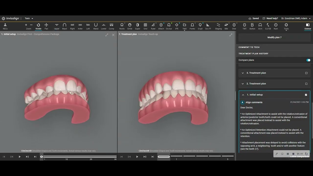 Expansion of the DENTAL arch with braces and NO palatal expander or headgear