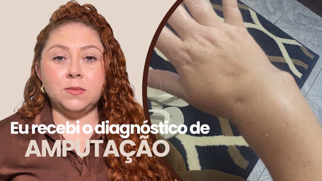 Tumor ósseo- TCG- Tumor de células gigantes! Quase amputei a mão. Testemunho.