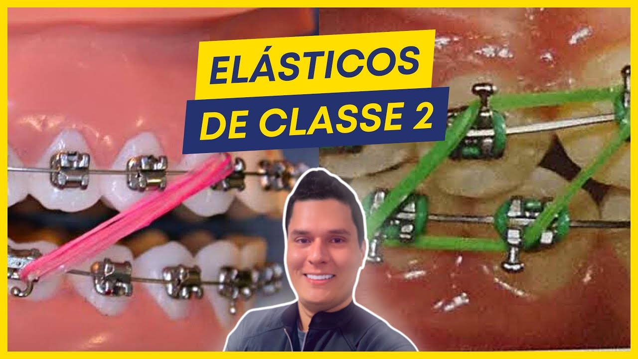 COMO TRATAR A CLASSE 2 COM ELÁSTICOS?  (PASSO A PASSO).