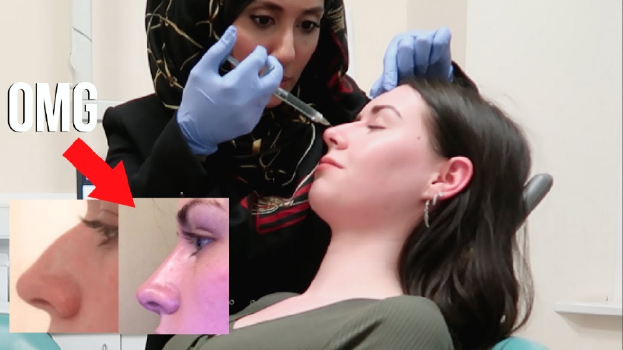 I got a Non Surgical Nose Job in 5 Minutes