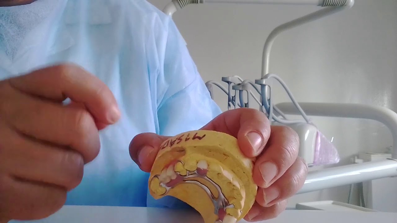 أنواع أطقم الأسنان 2