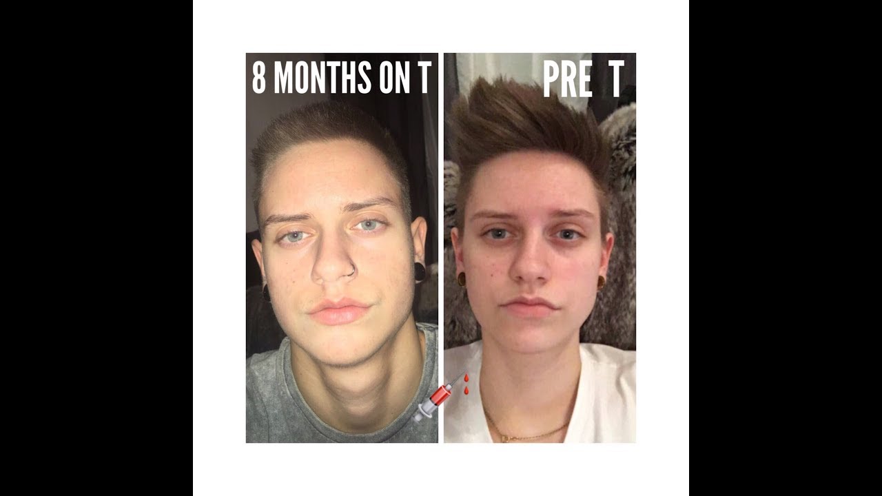 FTM: 8 MONATE AUF TESTOSTERON 💉