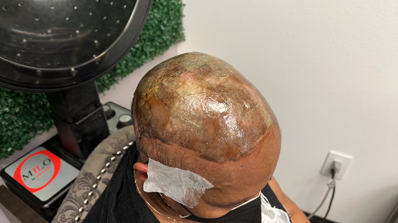 Her hair won’t grow anymore| Alopecia Hair Weave| Alopecia Scarring