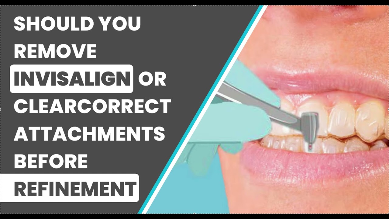 Should you Remove Invisalign Attachments before Refinement