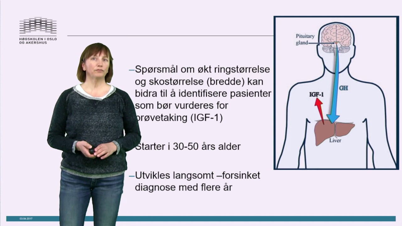 Akromegali