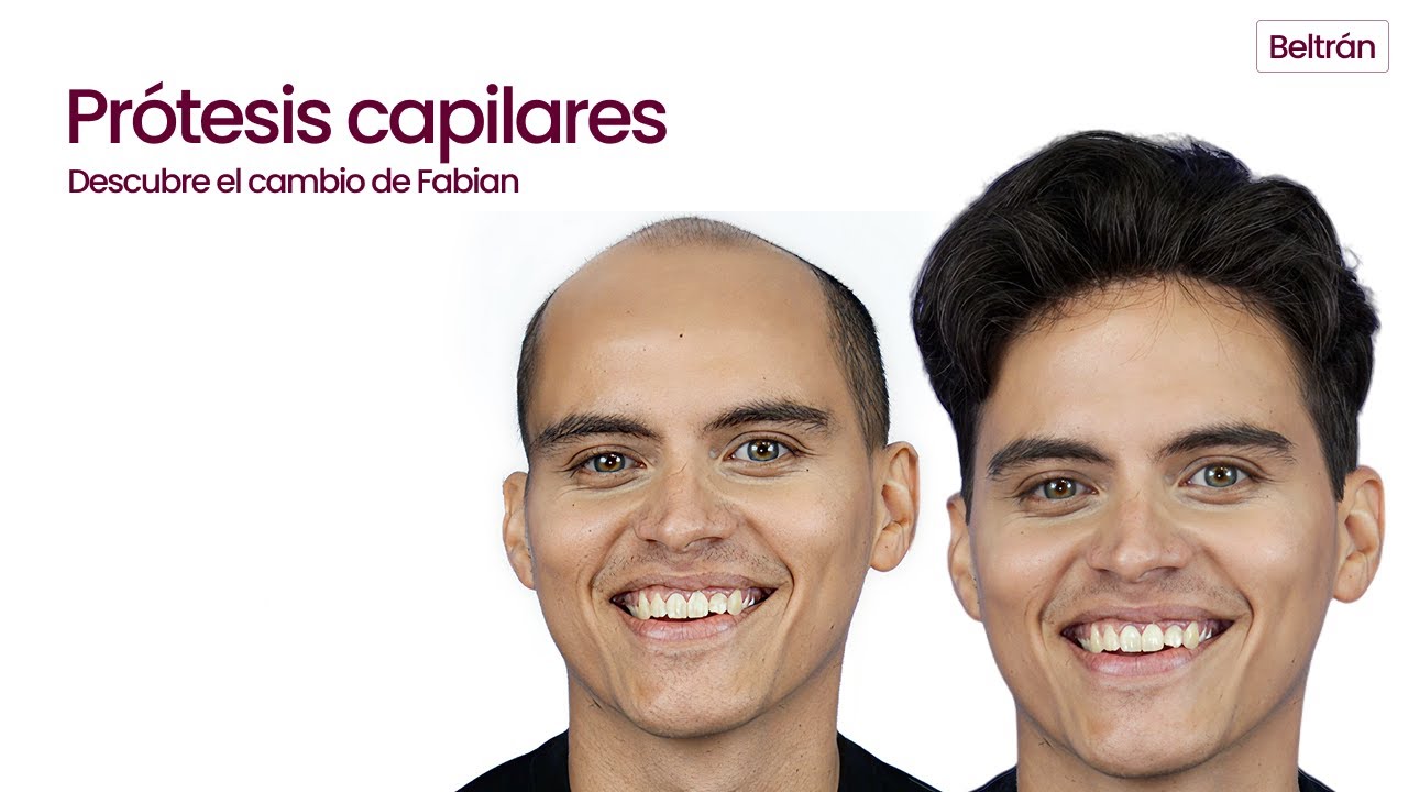 Prótesis Capilar para Hombre - Descubre el cambio de Fabian!