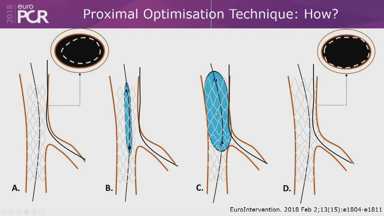 bifurcation lesions most important, part1.